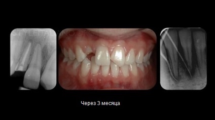 Външно възпалително кореновата резорбция на зъби