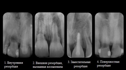 Külső gyulladásos gyökérreszorpció fogak