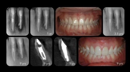 Külső gyulladásos gyökérreszorpció fogak