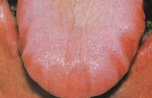 Jagged szélén nyelv (a nyelv a fogaskerék) - Kép, okai, kezelése