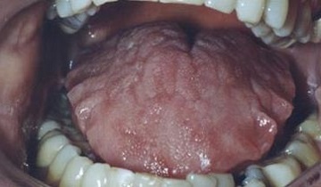 Jagged szélén nyelv (a nyelv a fogaskerék) - Kép, okai, kezelése