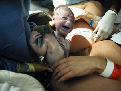 Circumcizia cauzelor și semnele cordonului ombilical