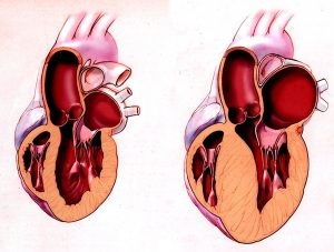 Pericolul modificărilor distrofice ale miocardului