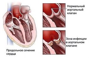 Complicații după angină pe urechi, articulații, inimă și alte organe
