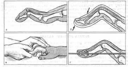 Fractura extensorului extensorului degetului