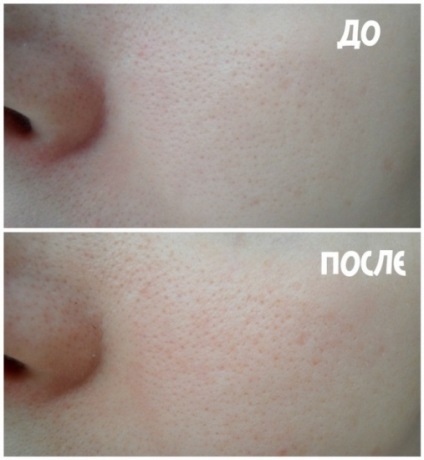 Cuplu de exfoliac noreva