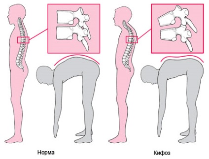 Cifoza patologică a coloanei vertebrale toracice și simptome