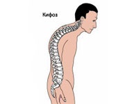 Cifoza patologică a coloanei vertebrale toracice și simptome