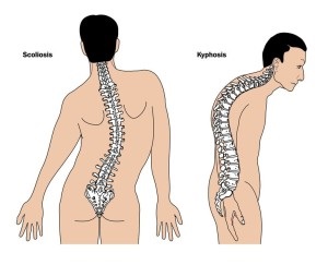 Cifoza patologică a coloanei vertebrale și tratamentul acesteia
