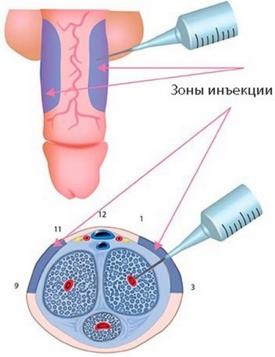 A corpus cavernosum a pénisz szerkezet, funkció, a trauma, a kezelés, injekció