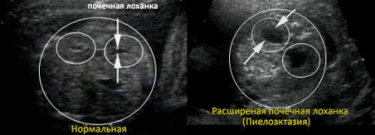 Piroeloctazia renală dreaptă și stângă la adulți și copii