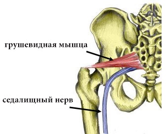 Sindromul Piriformis