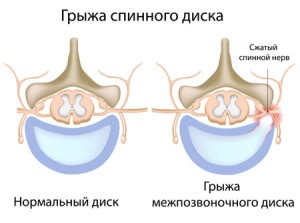 Nutriție și dietă cu o hernie a coloanei vertebrale - clinica medicului Ignatiev
