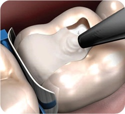 Stampile dentare, tipuri de etanșări moderne, umplerea dinților