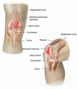 De ce durerile articulațiilor genunchiului, cauzele durerii severe, decât tratamentul genunchiului și ce trebuie să faceți
