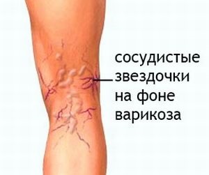 Защо по различни части на тялото се появяват разширени вени основните причини