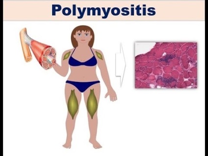 Simptomele și tratamentul polimiozitei, ce este?
