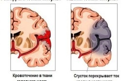 Efectele accidentului vascular cerebral la vârstnici