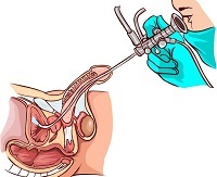 Implicații după intervenția chirurgicală pentru înlăturarea prostatei