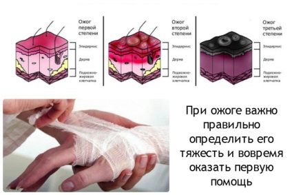 Îngrijirea adecvată pentru arsurile video de uz casnic