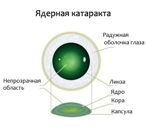 Cauzele cataractei de diferite tipuri
