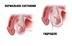 Az okok a hydrocele vagy hydrocele férfiaknál