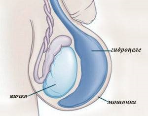 Az okok a hydrocele vagy hydrocele férfiaknál