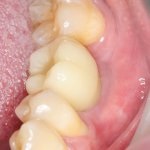 Dentiția dentară la copii înseamnă a ajuta la a face față durerii