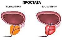 Prostatita - cauze, simptome, diagnostic și tratament