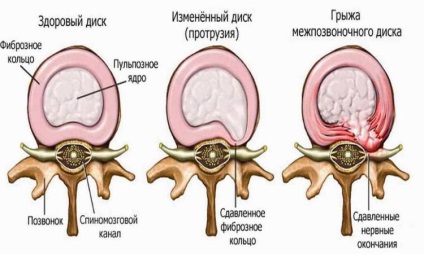 Protruzia tratamentului discurilor coloanei vertebrale cervicale, prevenire