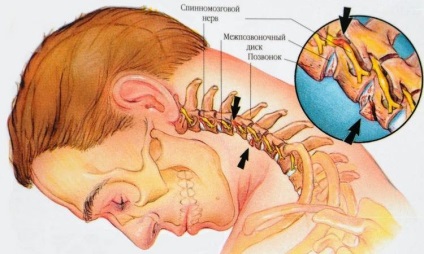 Protruzia tratamentului discurilor coloanei vertebrale cervicale, prevenire