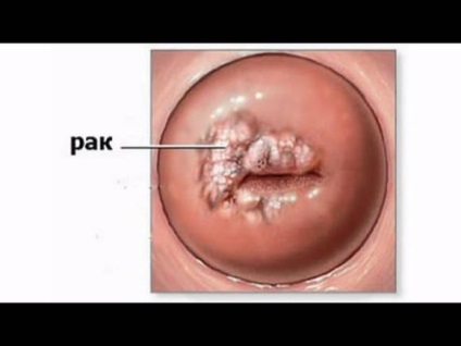 Simptome și semne de cancer de col uterin
