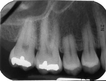 Resorbția rădăcinilor cauzate de dinți, tipuri, tratament