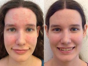 Seborrhoeás dermatitis okozza, tünetei, kezelése, fotók, blog haj