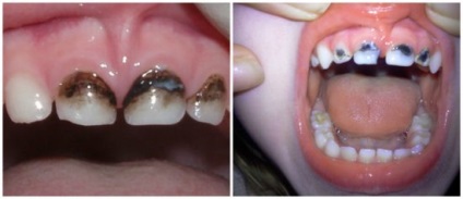 Argintarea dinților în efectul copiilor, recenzii, dinți din lapte