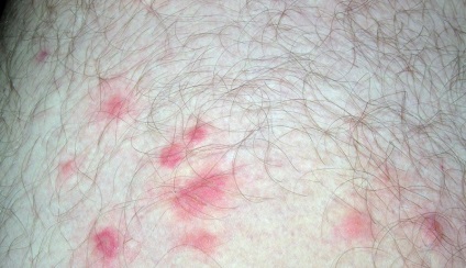 Simptomele de mușcături de bug-uri pat roșu, a arătat câteva piese, cum arată, dacă