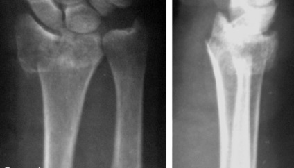 Sindromul de mâncărime după o fractură a unei oase radiale a unei mâini