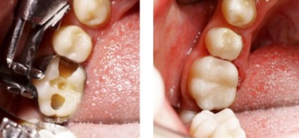 Câte sigilii există în dinte, durabilitate, cum se prelungește durata de viață