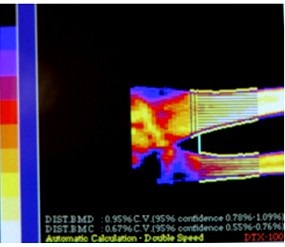 Imagini ale oaselor pacienților înainte și după aplicarea preparatului - osteomed - preparate pentru tratament și