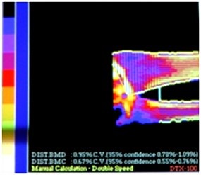 Imagini ale oaselor pacienților înainte și după aplicarea preparatului - osteomed - preparate pentru tratament și