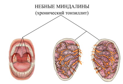 Mandulagyulladás, Otolaryngology (ENT), Preobrazhenskaya Clinic