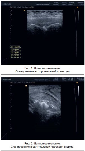 Diagnosticarea ultrasonică a stării articulației pubian la femei, logutova l