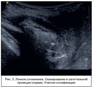 Diagnosticarea ultrasonică a stării articulației pubian la femei, logutova l