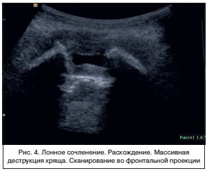 Diagnosticarea ultrasonică a stării articulației pubian la femei, logutova l