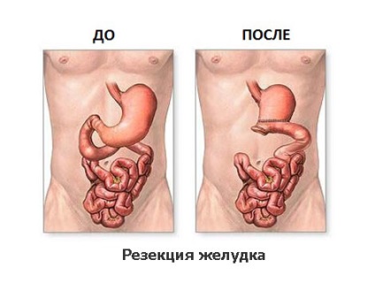 Sigiliile din zona stomacului cauzează, simptome, tratament