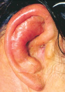 Lobul urechilor la om - cauze, tipuri, manifestări, tratament