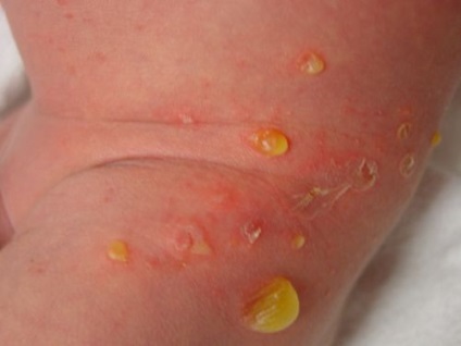 Tipuri de impetigo streptococic buloase, fise, turnamentol, în formă de inel