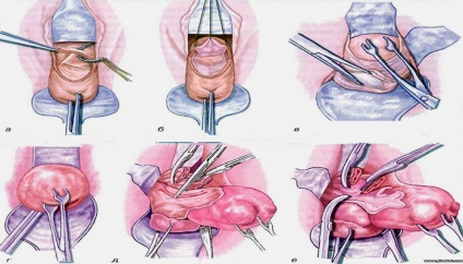Căderea părului după îndepărtarea uterului și a ovarelor, după îndepărtarea uterului și a căderii părului cade