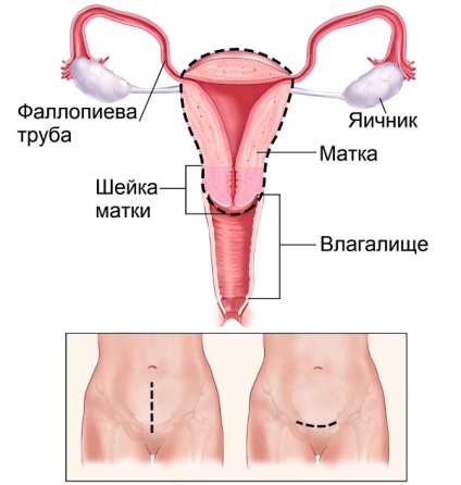 Căderea părului după îndepărtarea uterului și a ovarelor, după îndepărtarea uterului și a căderii părului cade