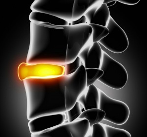 Extensia în hernia coloanei vertebrale cervicale și lombare